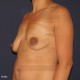 Mastopexia, pexia levantar  pecho, elevar mama, cirugía eatérica métodos